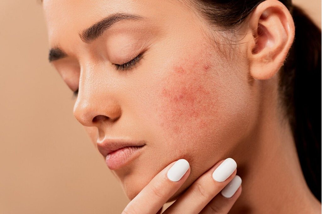 acne, pimples, spots